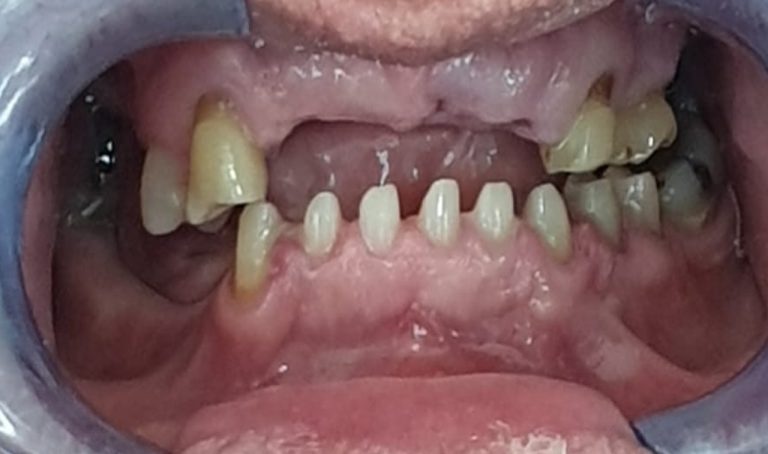 Dr. Philippe Chanavaz performing oral surgery in Dubai clinic